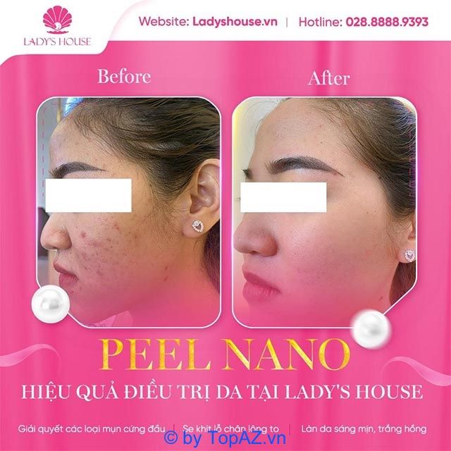 Dịch vụ điều trị sẹo tại Lady’s House Spa Bình Dương