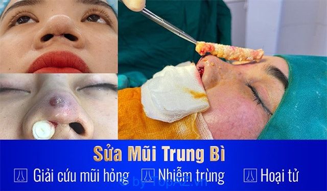 Bác sĩ Bùi Văn Cường chuyên sửa mũi hỏng tại Hà Nội