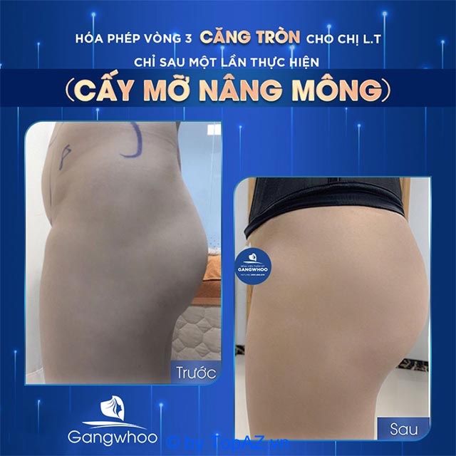 Cấy mỡ nâng mông tại Thẩm mỹ viện Gangwhoo