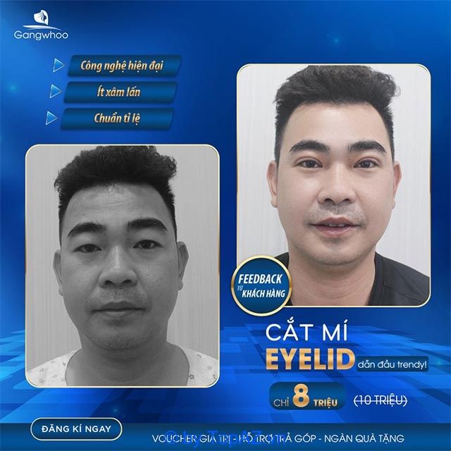 Cắt mí Eyelid tại Thẩm mỹ viện Gangwhoo