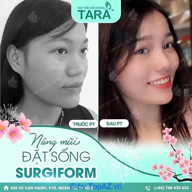 TARA Beauty Clinic – nâng mũi tinh tế và hiệu quả