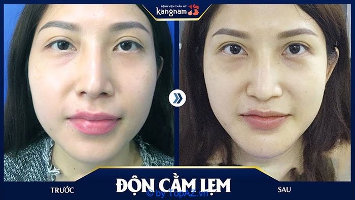 Bệnh viện thẩm mỹ Kangnam có đáng tin cậy không, có nguy cơ gây tai biến không?