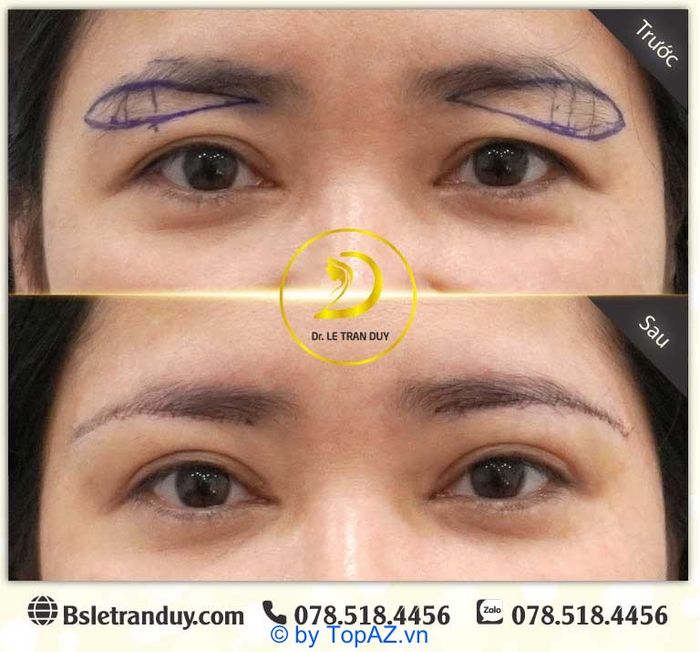 Có Nên Thực Hiện Nâng Cung Chân Mày?