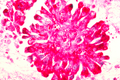 Sarcoma (u xương)