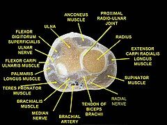 Cơ của cẳng tay, bao gồm phần bám tận của cơ cánh tay. ('Brachialis' (cơ cánh tay) nằm ở góc dưới bên trái.)