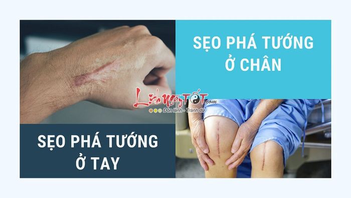 Sẹo phá tướng ở tay, chân