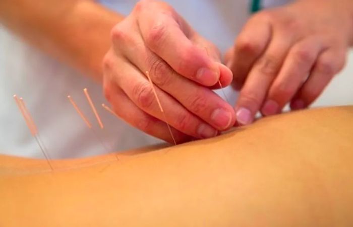 a therapist applying acupuncture needles on the back of a young woman