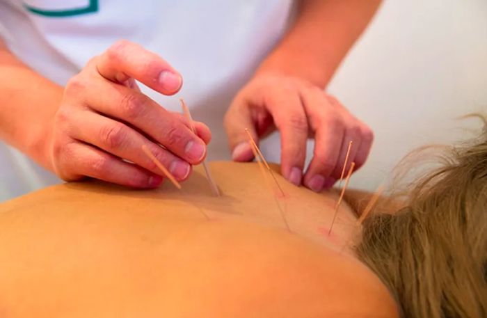 woman undergoing acupuncture treatment by a massage therapist