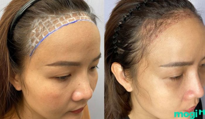 Cải thiện hình dáng trán chữ M