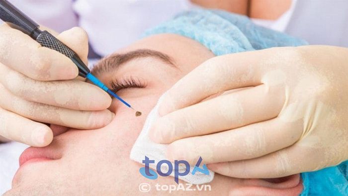 Địa chỉ xóa nốt ruồi tại Quận 6