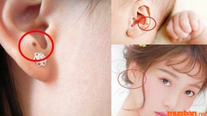 Nốt ruồi ở tai có ý nghĩa gì đối với tướng số?