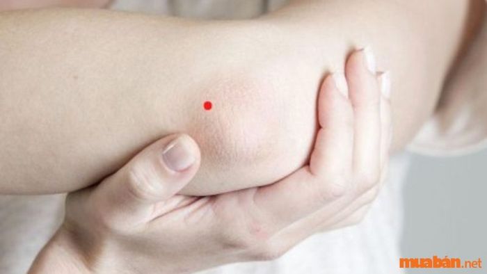 Nốt ruồi son ở khuỷu tay trái