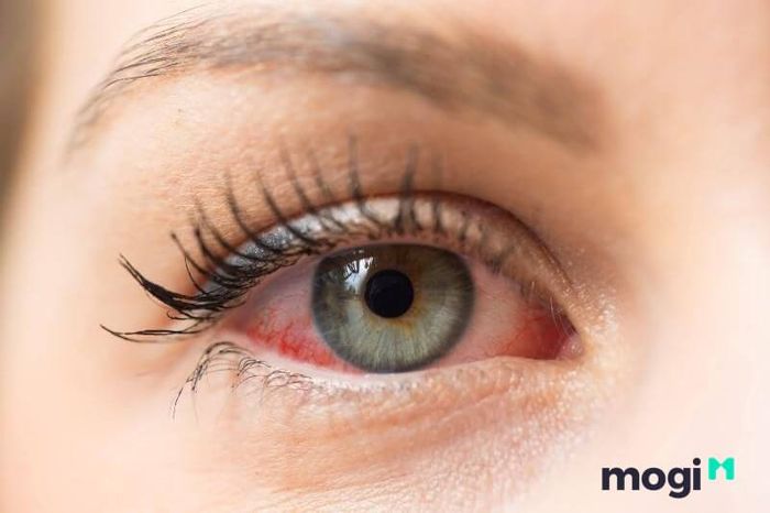 Mí mắt co giật có thể là dấu hiệu cảnh báo vấn đề sức khỏe nghiêm trọng, theo quan điểm khoa học.