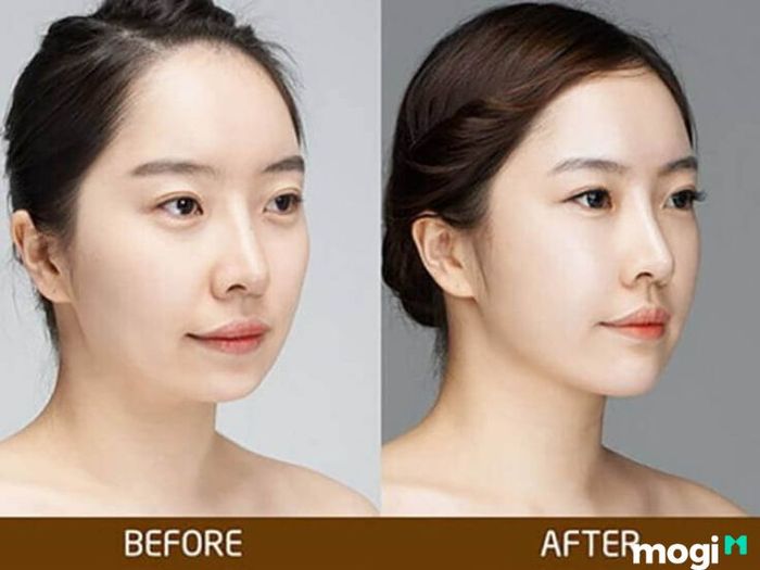 Cằm lẹm có thể là hệ quả của ung thư răng miệng, khi các khối u hoặc sự can thiệp điều trị ảnh hưởng đến cấu trúc hàm dưới.