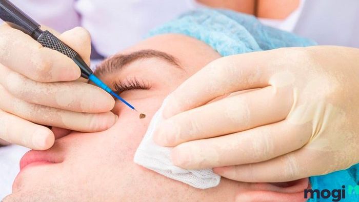 Lưu ý khi xóa nốt ruồi