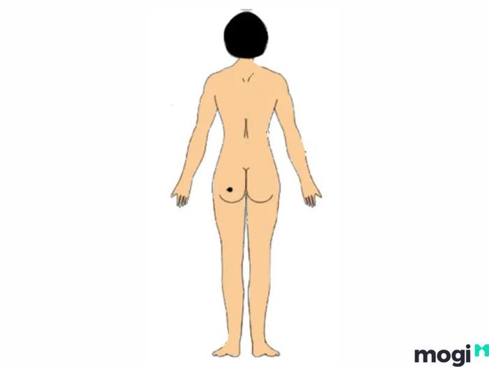 Nốt ruồi phú quý ở mông