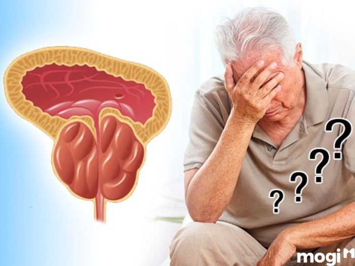 Giảm kích thước tuyến tiền liệt hiệu quả
