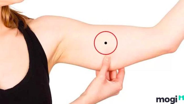 Nốt ruồi trên cánh tay