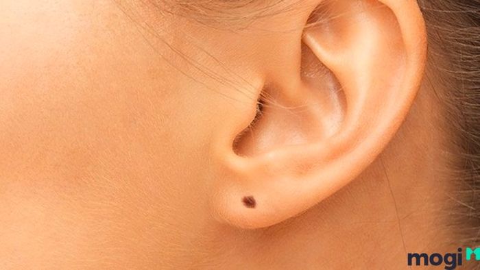 Nốt Ruồi Phú Quý Ở Vành Tai