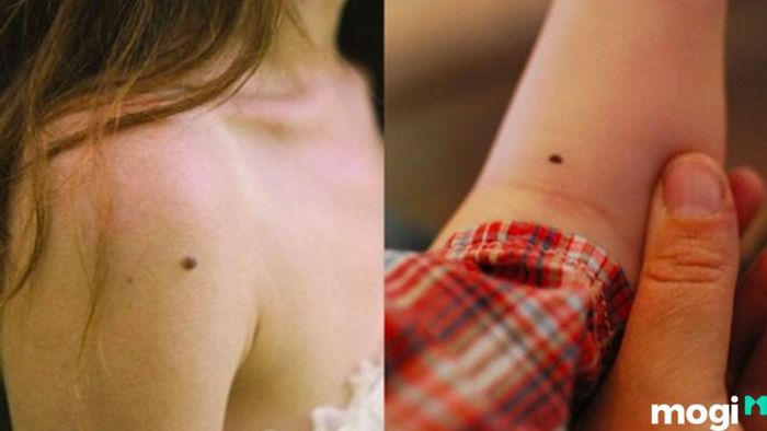 Nốt ruồi phú quý trên cánh tay