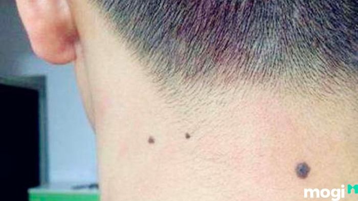 Nốt Ruồi Phú Quý Nằm Sau Gáy