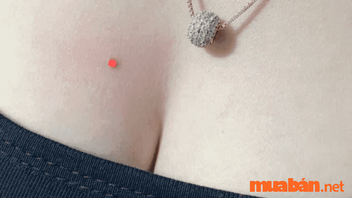 nốt ruồi trên ngực
