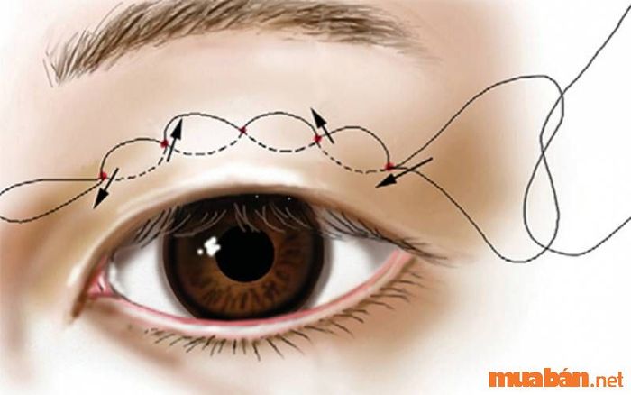 Bấm mí mắt để sở hữu đôi mắt bồ câu tự nhiên