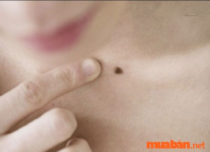 Nốt ruồi ở xương quai xanh tại hõm đầu
