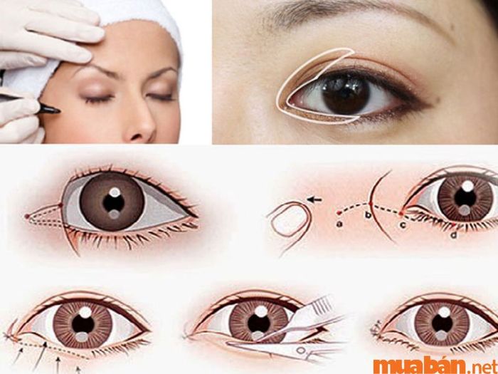 Áp dụng phương pháp phẫu thuật thẩm mỹ