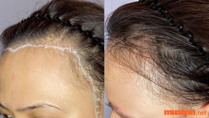 Cấy tóc giúp che khuyết điểm trán dô hiệu quả