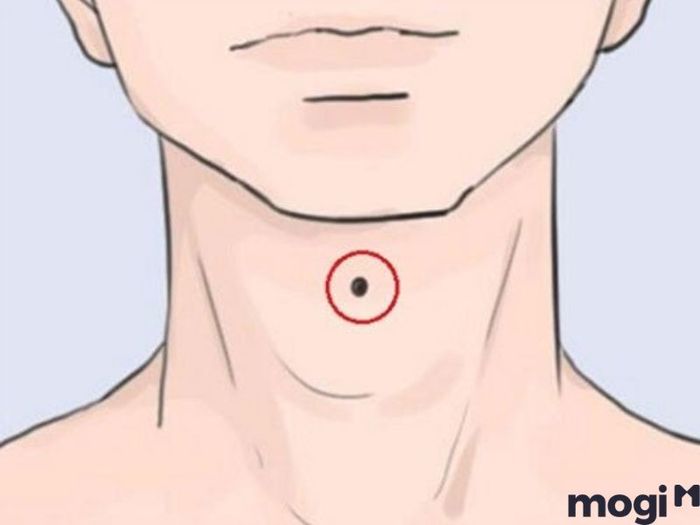 Nốt ruồi son tại khu vực yết hầu giữa cổ