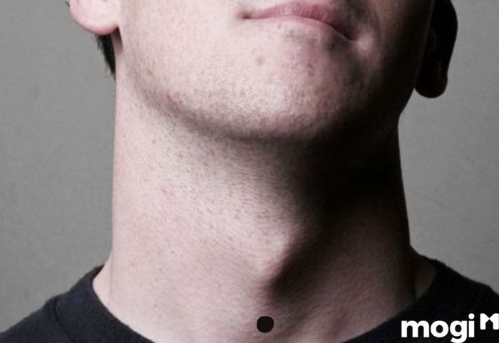 Nốt ruồi ở vị trí dưới cổ, ngay dưới yết hầu