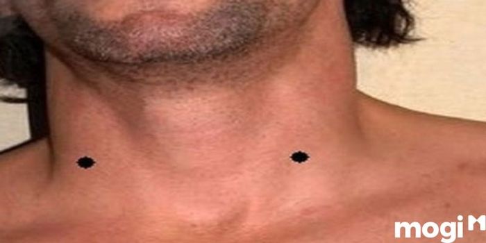 Hai Nốt Ruồi Song Song Trên Cổ