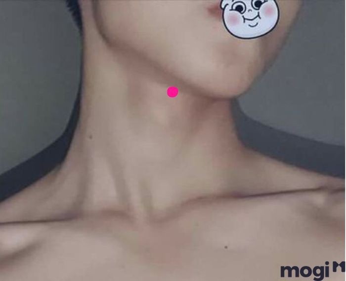 Nốt ruồi son ngay trên yết hầu