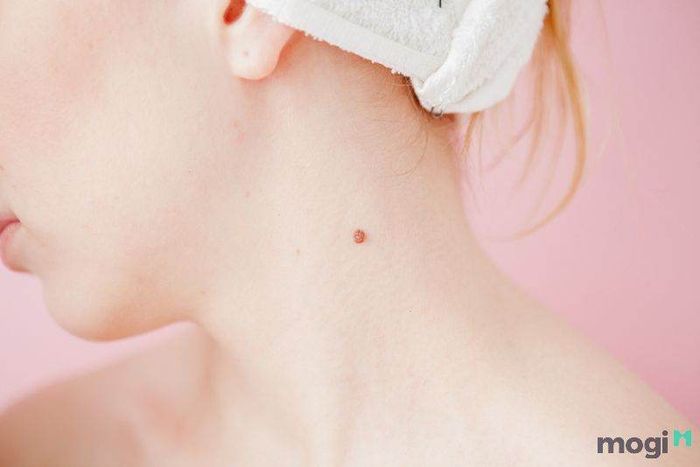 Nốt ruồi son tại cổ