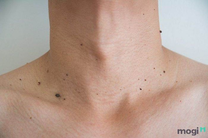 Nốt Ruồi Xung Quanh Cổ