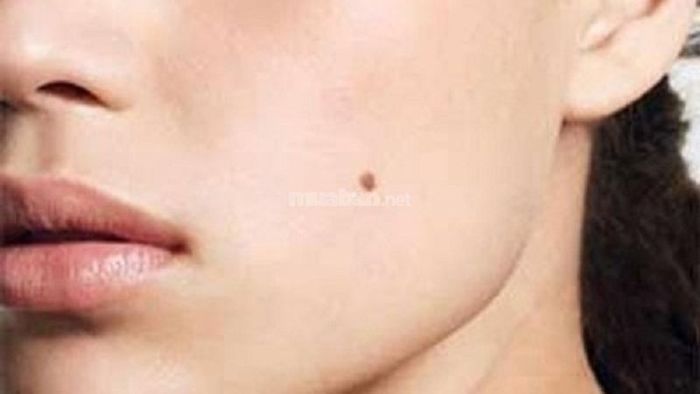 Những nốt ruồi không may mắn trên khuôn mặt