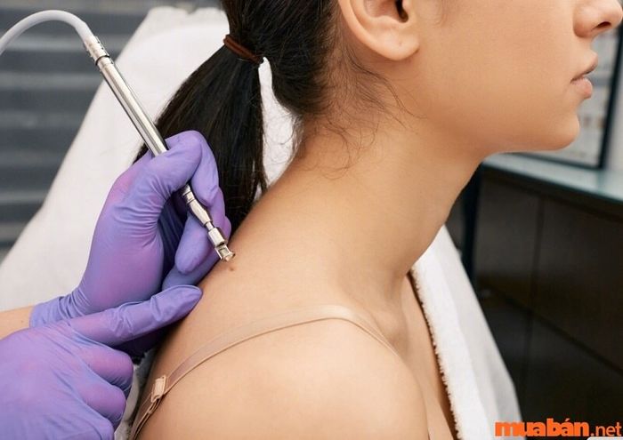 Hoạt hóa nốt ruồi là kỹ thuật tẩy nốt ruồi bằng thuốc hóa học.