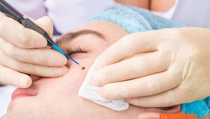 Khi quyết định tẩy xóa nốt ruồi, hãy lựa chọn những cơ sở uy tín để đảm bảo an toàn và hiệu quả.