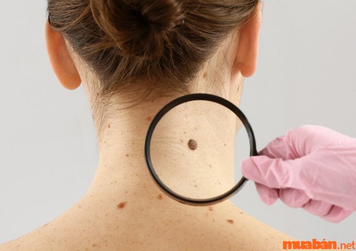 Nếu nốt ruồi có dấu hiệu bất thường, hãy đi khám ngay để đảm bảo sức khỏe.