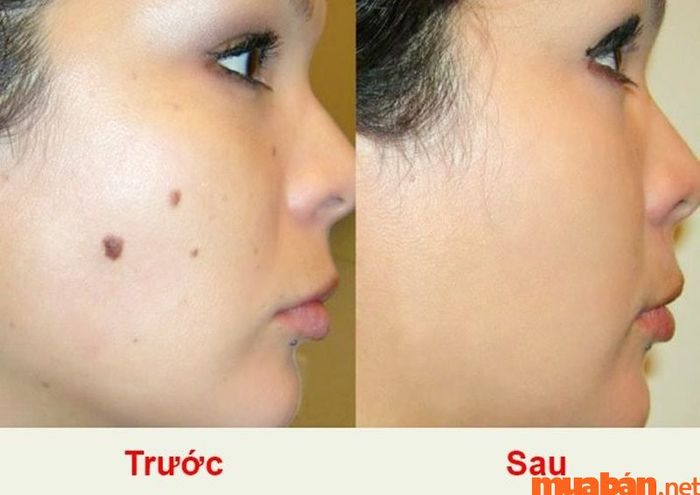 Nếu nốt ruồi làm ảnh hưởng đến vẻ đẹp của khuôn mặt, bạn hoàn toàn có thể cân nhắc việc tẩy xóa nó.