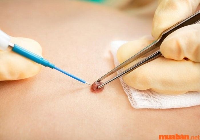 Khi xóa nốt ruồi sau gáy, bạn cần lựa chọn địa chỉ uy tín và chú ý đến tính thẩm mỹ của kết quả.