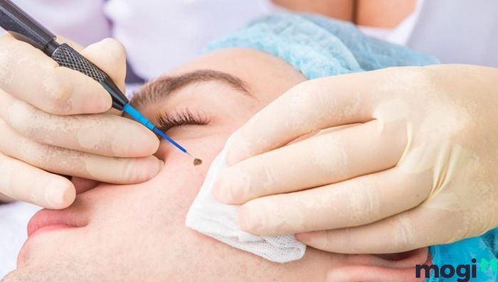 nốt ruồi ở vùng xương quai xanh