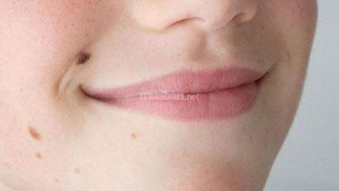 Ý nghĩa nốt ruồi ở vị trí rãnh cười