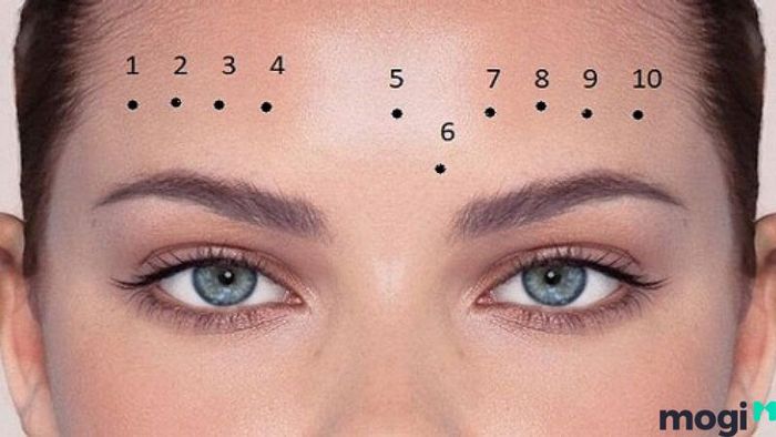 Nốt ruồi trên trán