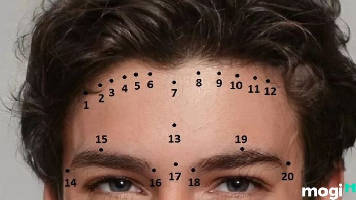 nốt ruồi trên trán