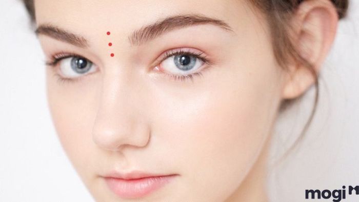 nốt ruồi ở trán