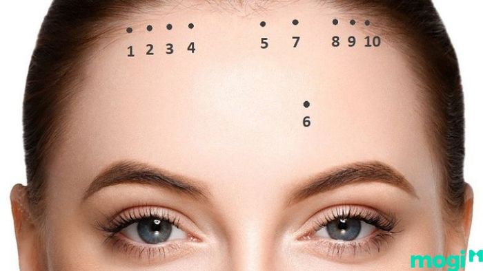 nốt ruồi ở trán