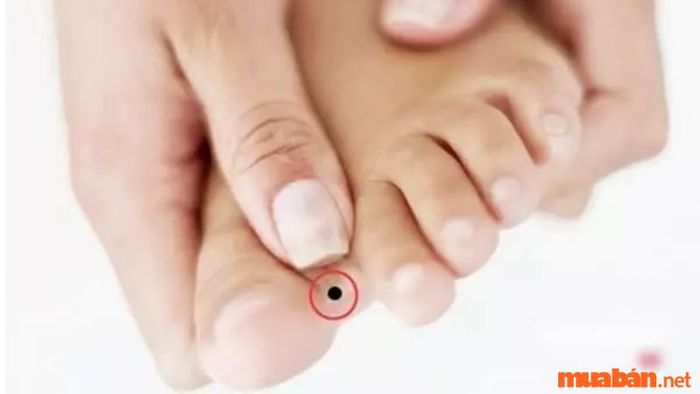 Nốt ruồi ở khe giữa ngón cái và ngón chân trỏ