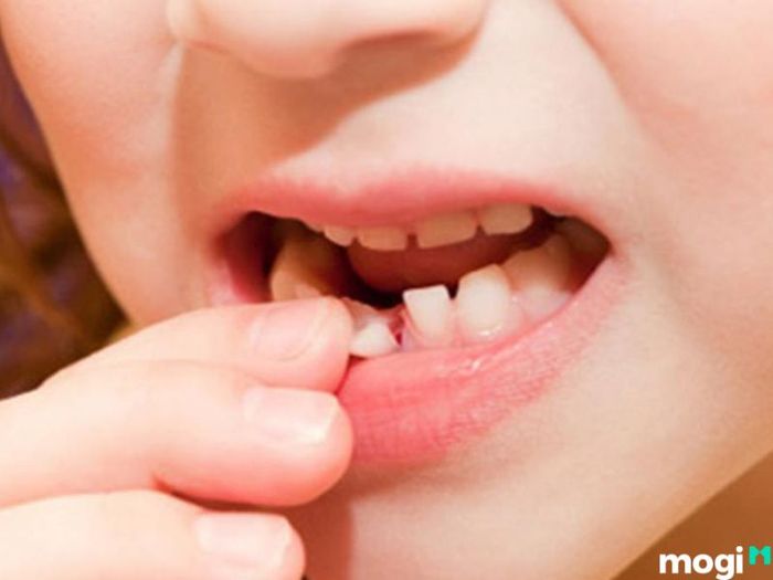 Giải Thích Ý Nghĩa Khi Nằm Mơ Thấy Rụng Răng
